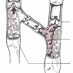 Tiefe Venenentzündung (Tiefe Venenthrombose)